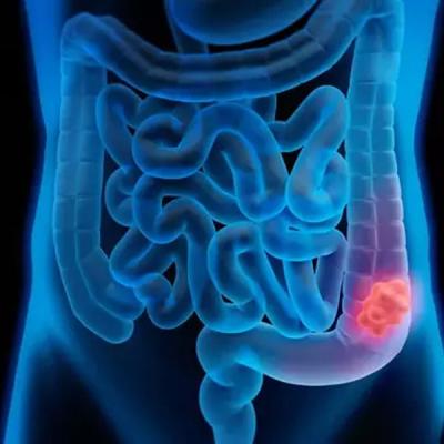 වැඩිහිටියන් සහ ළමුන් අතර ගුද මාර්ග පිළිකා තත්ත්වවල ඉහළ යෑමක්